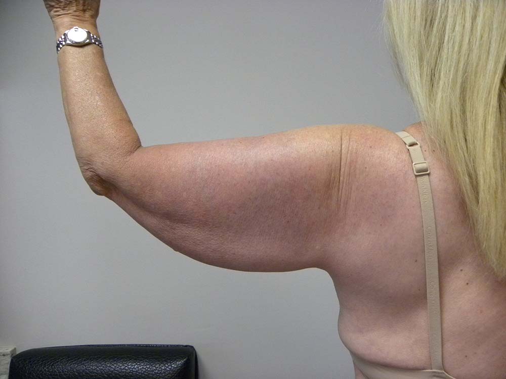 Arm Lift Before and After Pictures Miami, FL