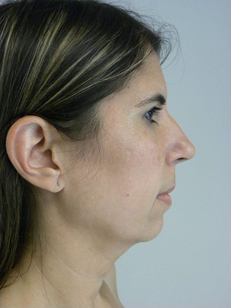 CHIN IMPLANT BEFORE AND AFTER PICTURES IN MIAMI, FL