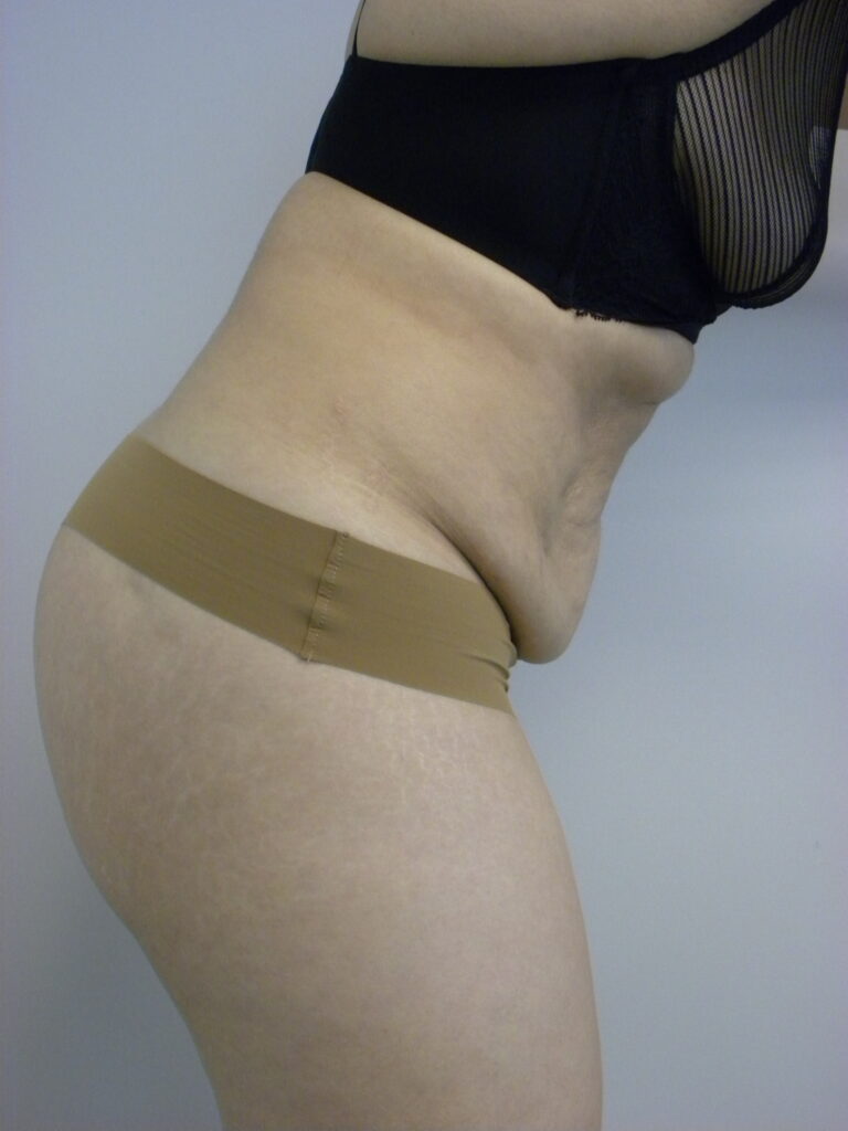 TUMMY TUCK BEFORE AND AFTER PICTURES IN MIAMI, FL