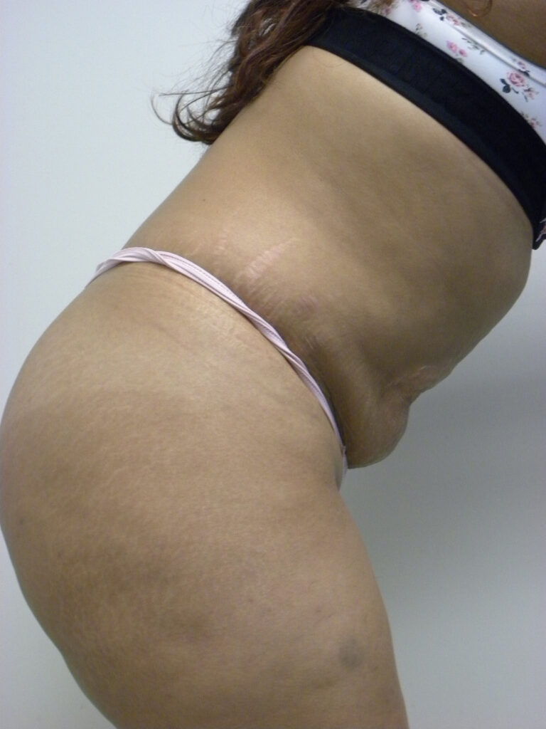 Tummy Tuck Before and After Pictures in Miami, FL