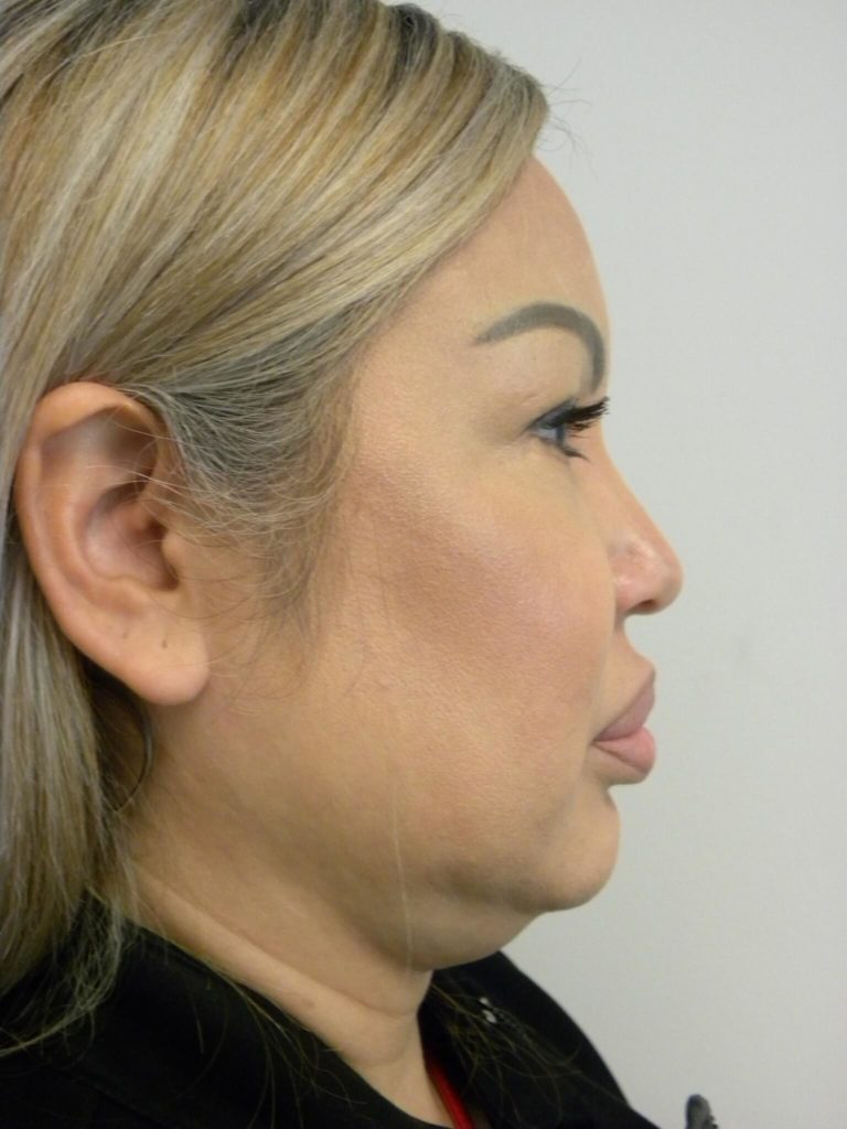 Minimally Invasive Neck Lift with Ellevate Before and After Pictures Miami, FL