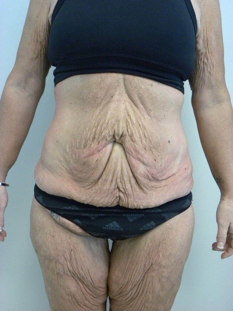 Tummy Tuck Before and After Pictures in Miami, FL