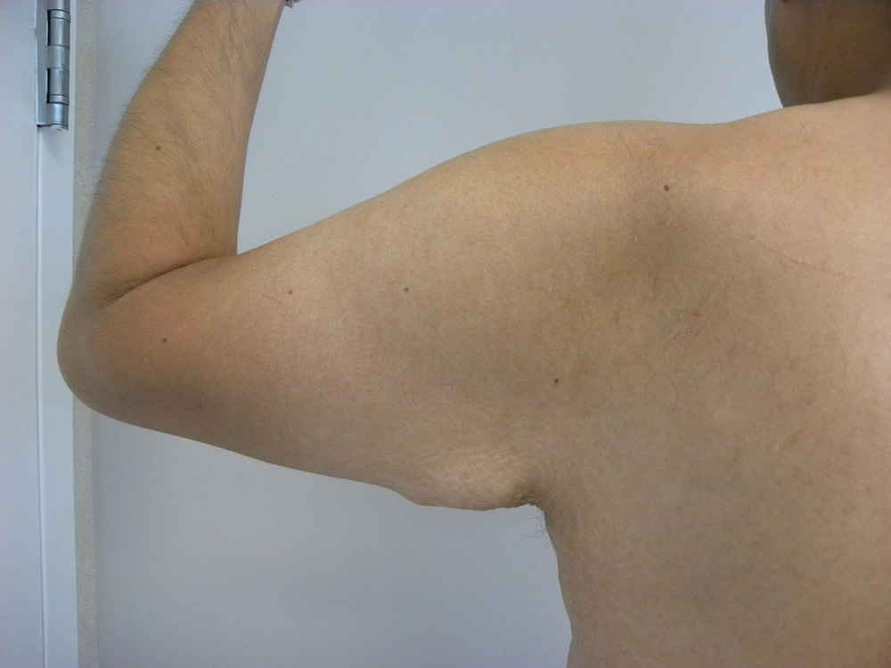 Plastic Surgery Before and After Pictures in Miami, FL - Dr. Adam J. Rubinstein 
