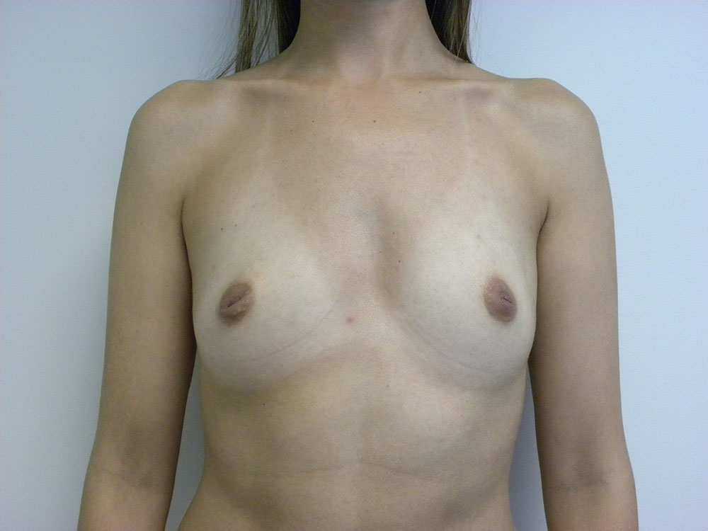 BREAST AUGMENTATION BEFORE AND AFTER PICTURES IN MIAMI, FL