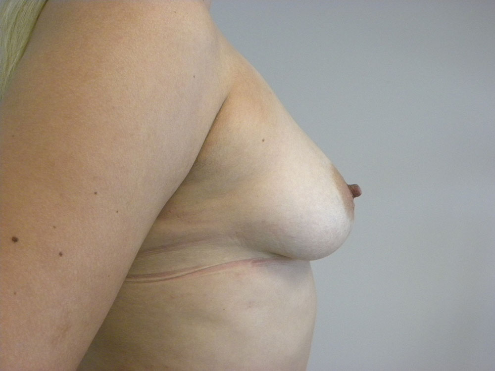 Plastic Surgery Before and After Pictures in Miami, FL - Dr. Adam J. Rubinstein 