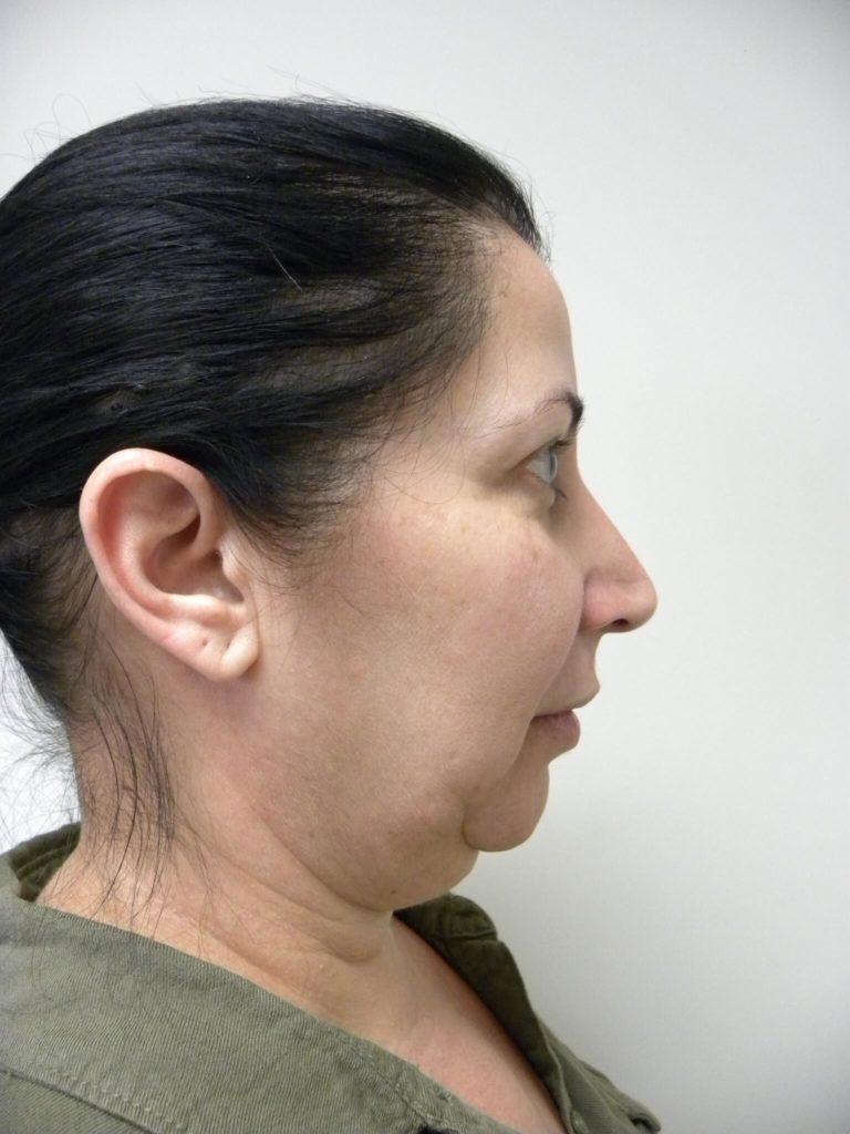 Minimally Invasive Neck Lift with Ellevate Before and After Pictures Miami, FL