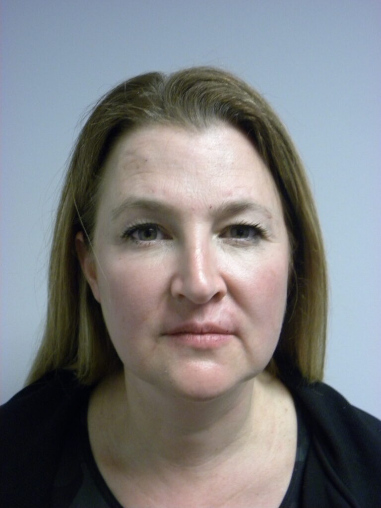 Plastic Surgery Before and After Pictures in Miami, FL - Dr. Adam J. Rubinstein 