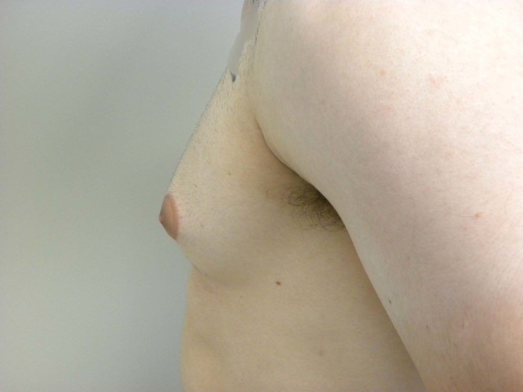Gynecomastia Before and After Pictures in Miami, FL