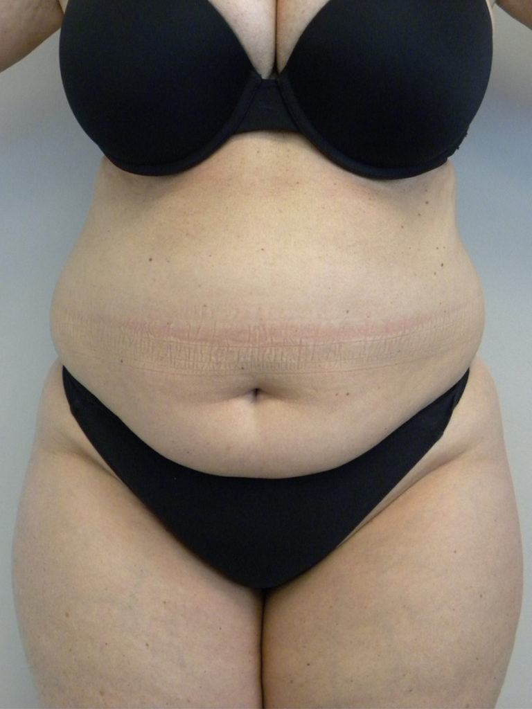 Liposuction Before and After Pictures Miami, FL