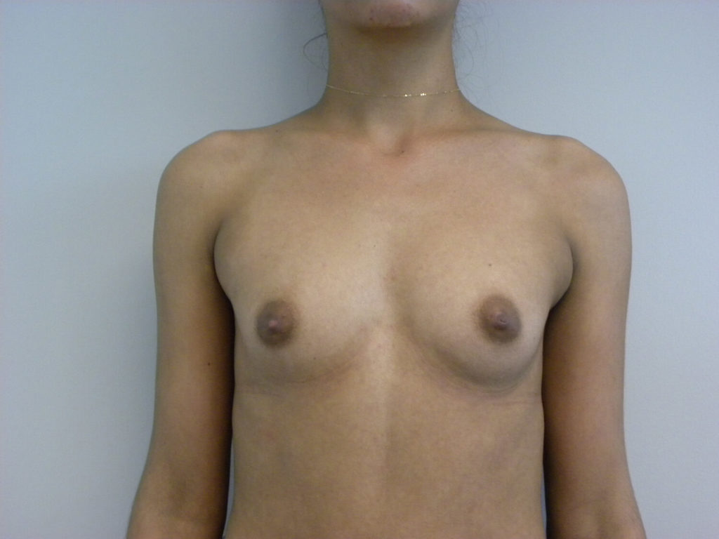 BREAST AUGMENTATION BEFORE AND AFTER PICTURES IN MIAMI, FL