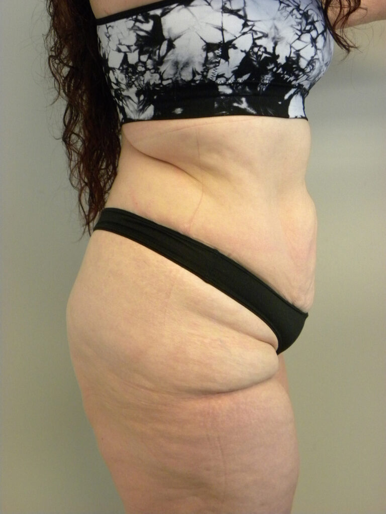 Body Lift Before and After Pictures Miami, FL