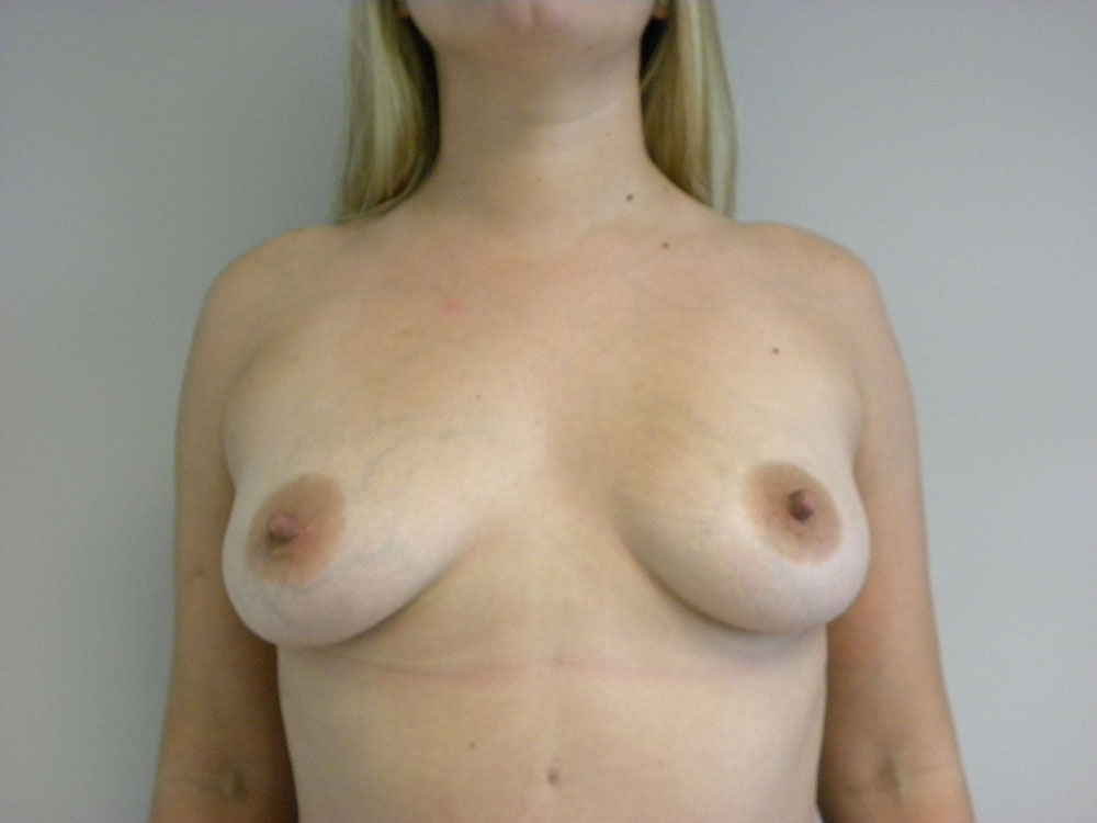 BREAST AUGMENTATION BEFORE AND AFTER PICTURES IN MIAMI, FL