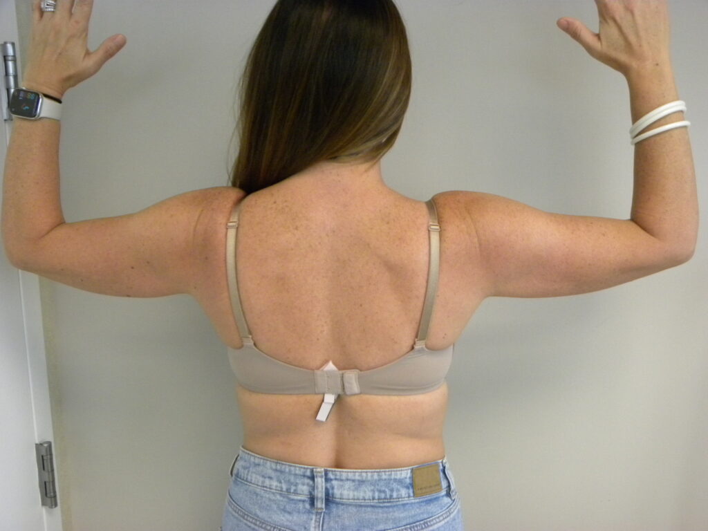 Plastic Surgery Before and After Pictures in Miami, FL - Dr. Adam J. Rubinstein 