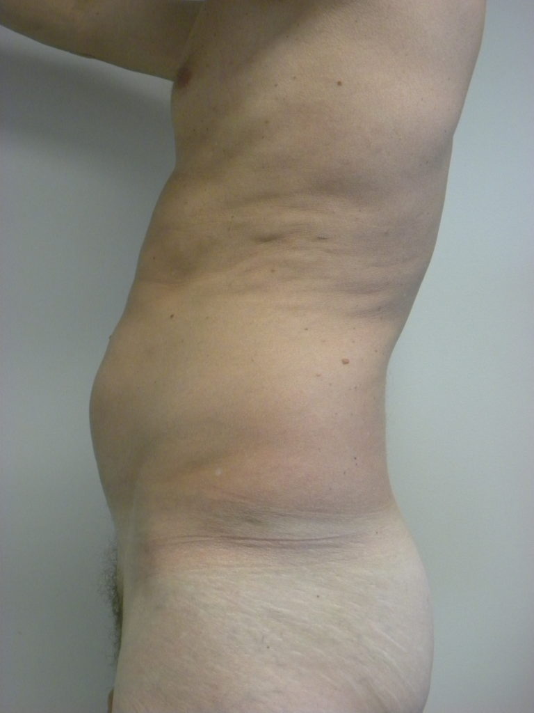 LIPOSUCTION BEFORE AND AFTER PICTURES IN MIAMI, FL
