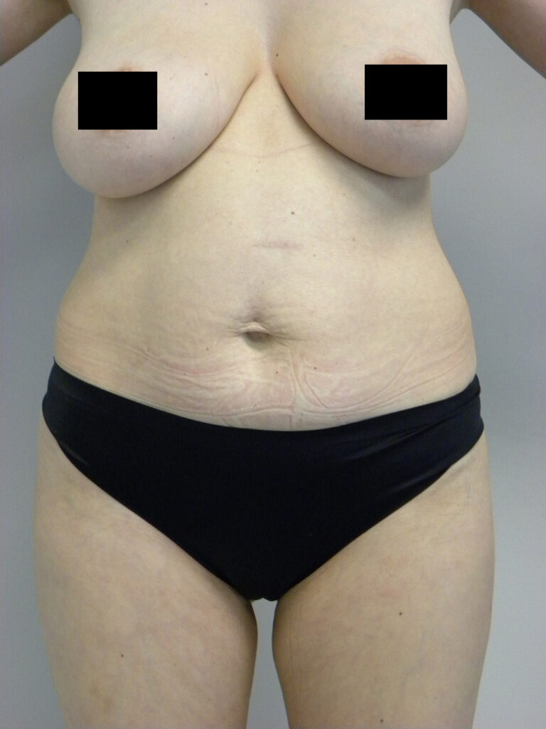 Tummy Tuck Before and After Pictures in Miami, FL