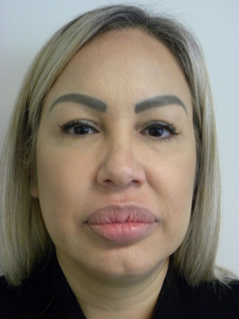 Neck Lift Before and After Pictures Miami, FL