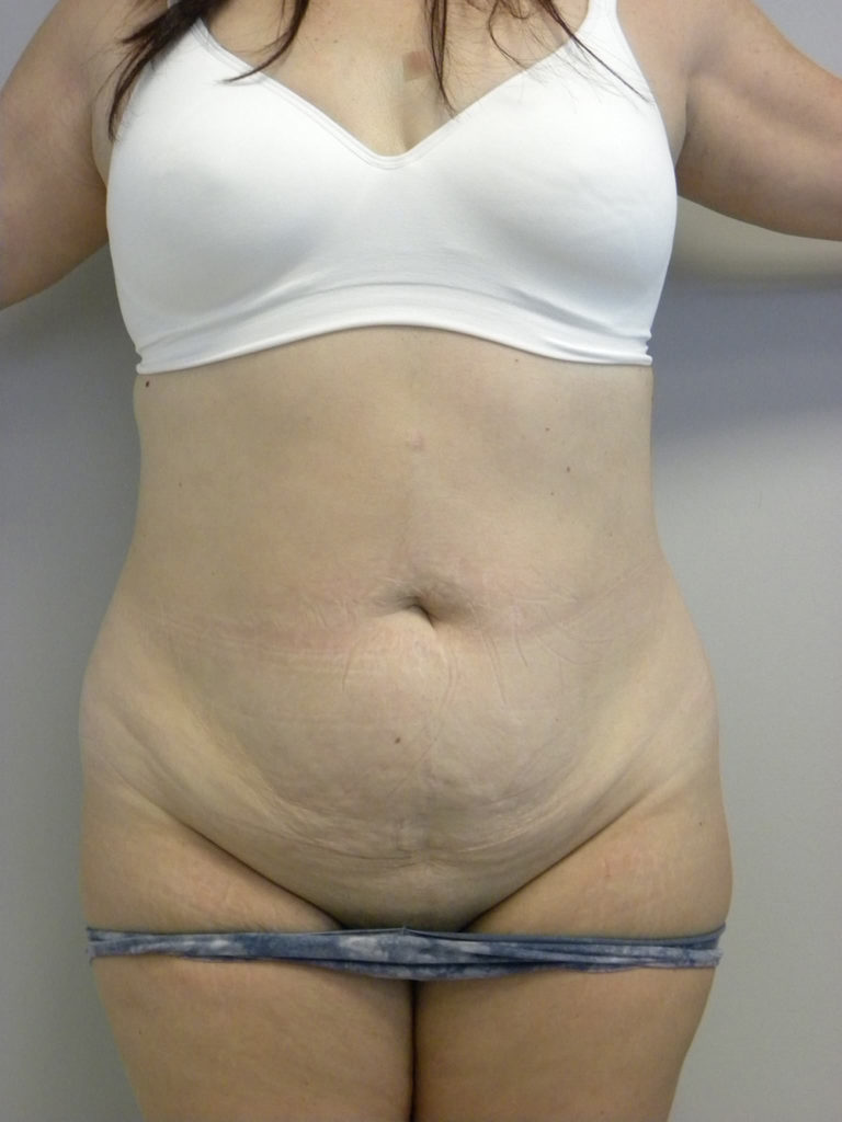 Tummy Tuck Before and After Pictures Miami, FL