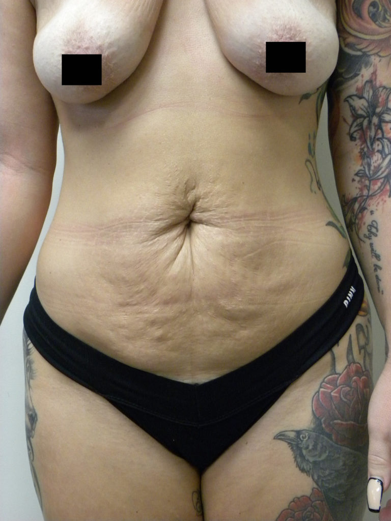 Tummy Tuck Before and After Pictures Miami, FL