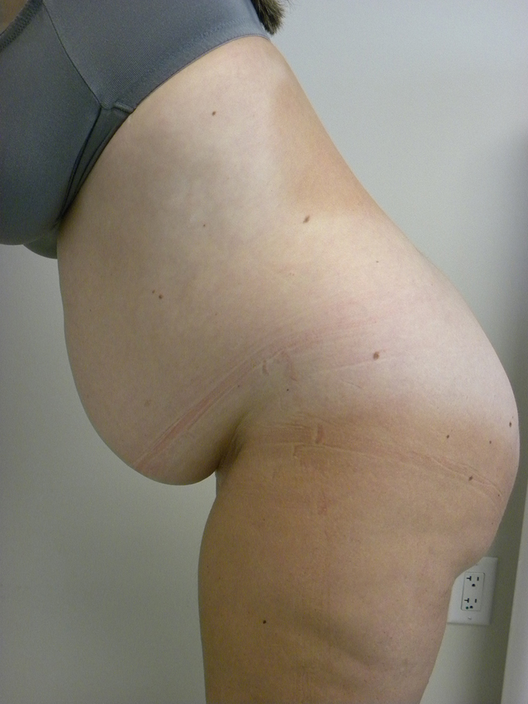 Tummy Tuck Before and After Pictures in Miami, FL