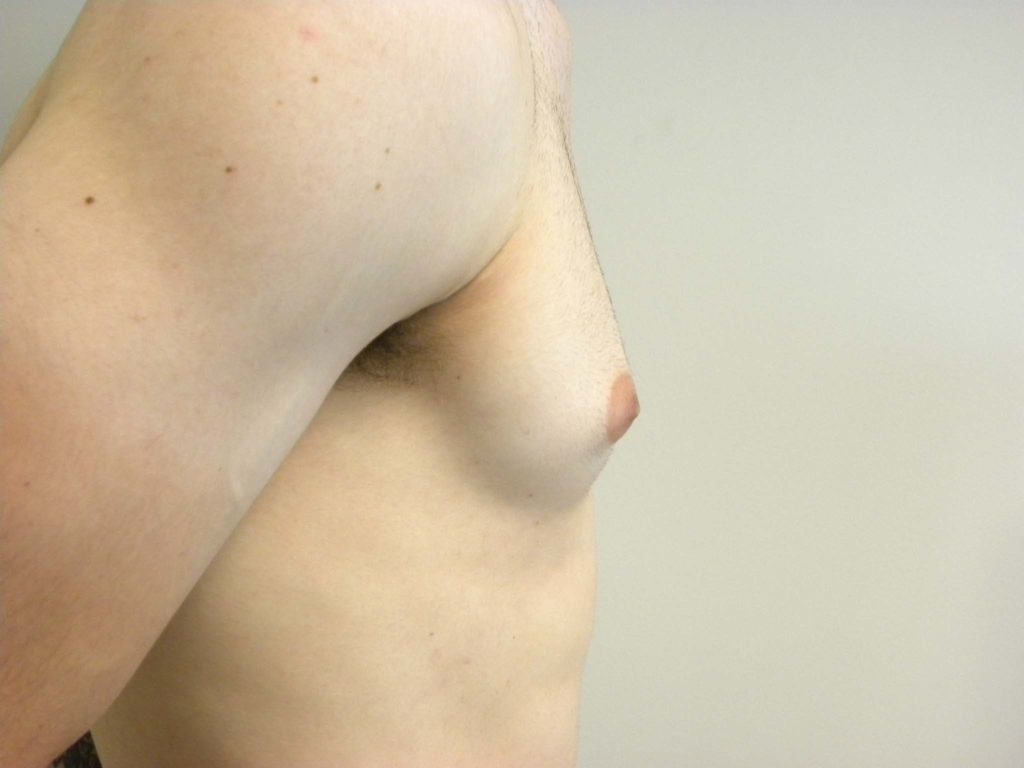 Gynecomastia Before and After Pictures in Miami, FL