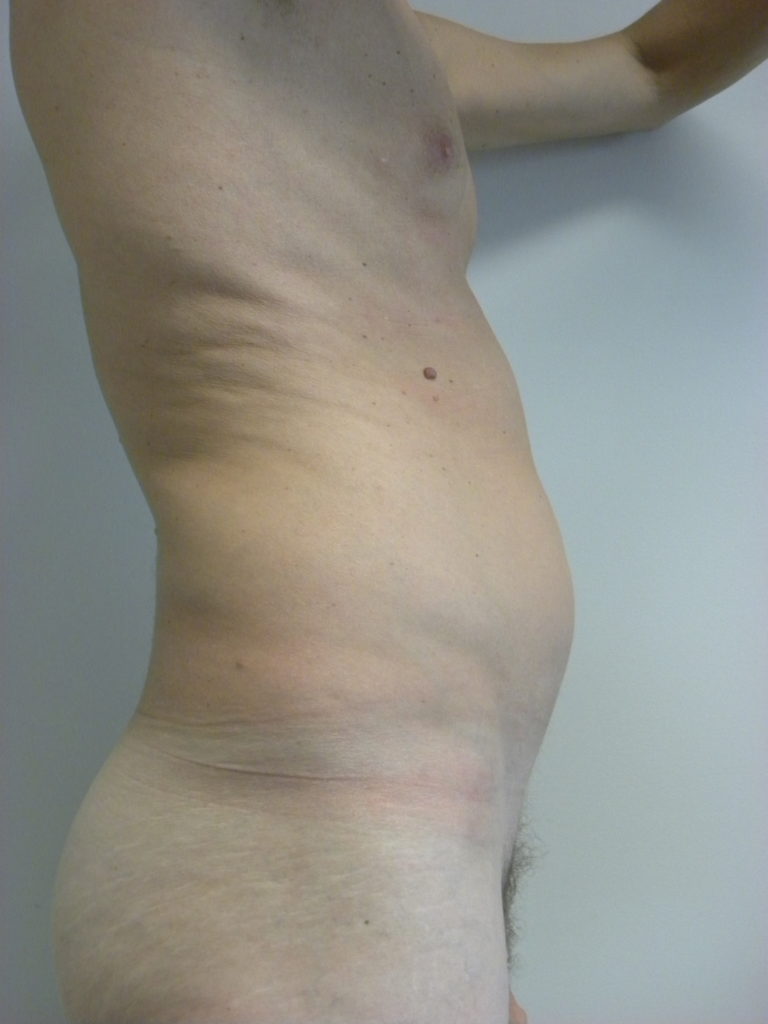 LIPOSUCTION BEFORE AND AFTER PICTURES IN MIAMI, FL