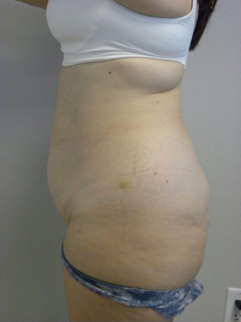 Tummy Tuck Before and After Pictures Miami, FL