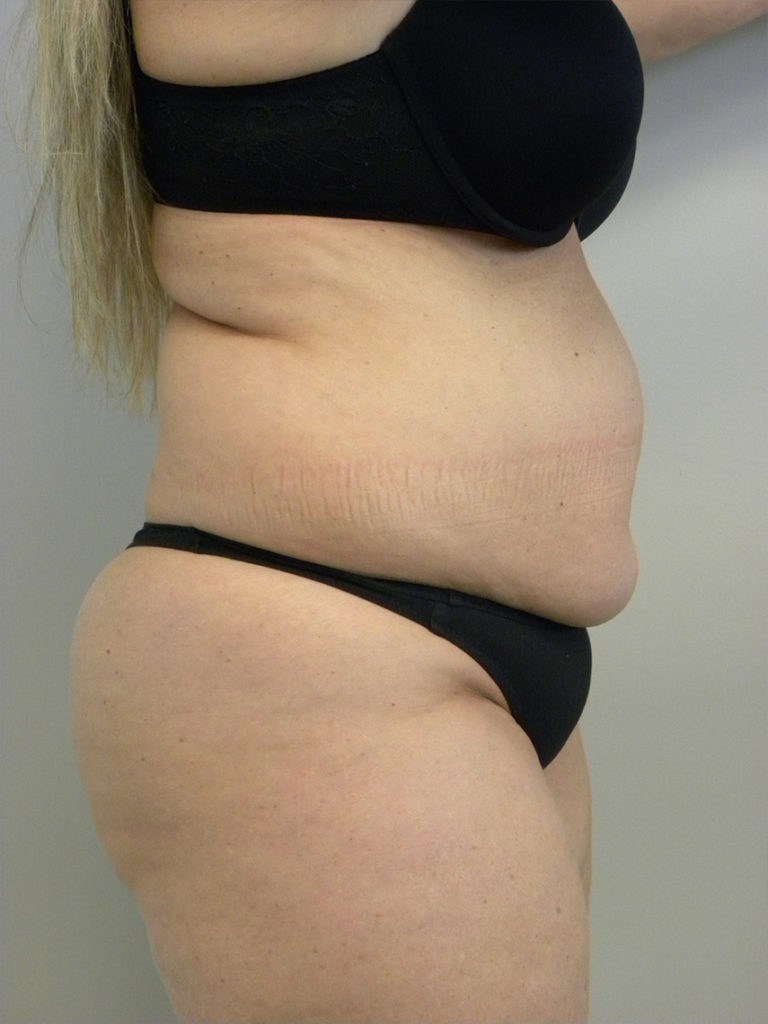 Liposuction Before and After Pictures Miami, FL