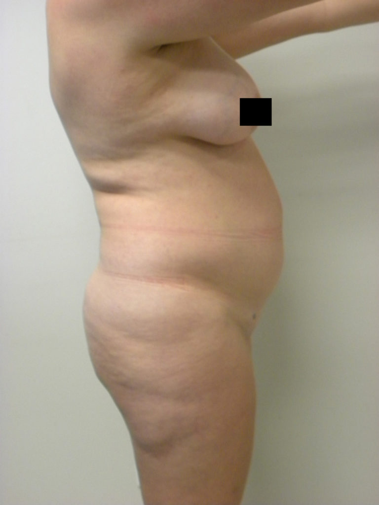 LIPOSUCTION BEFORE AND AFTER PICTURES IN MIAMI, FL