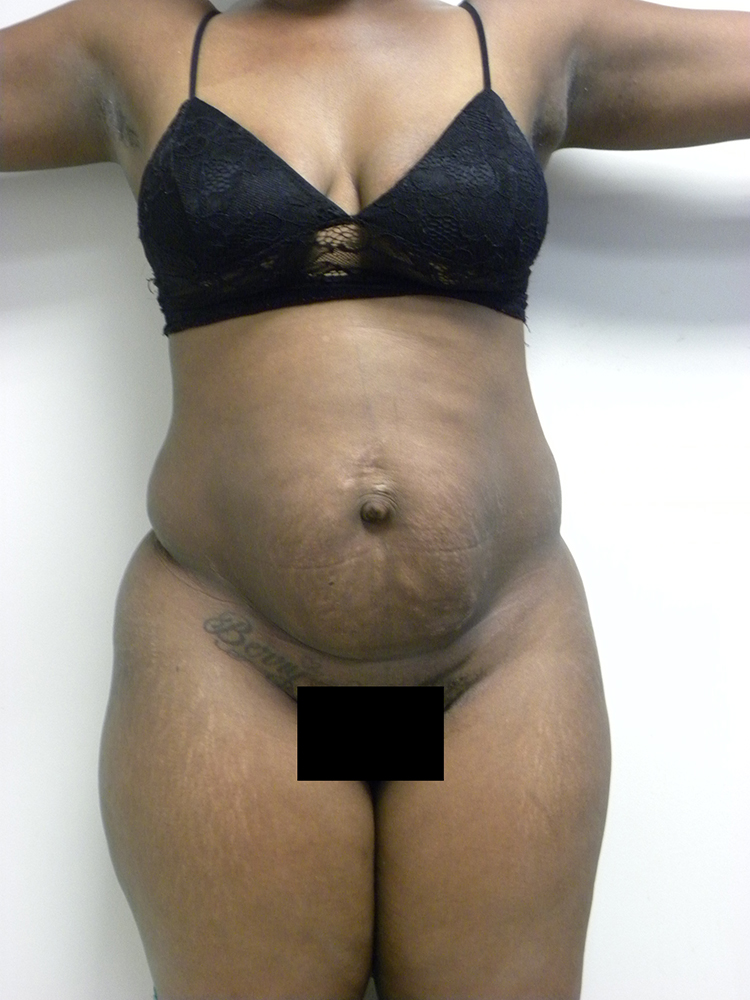 Tummy Tuck Before and After Pictures in Miami, FL