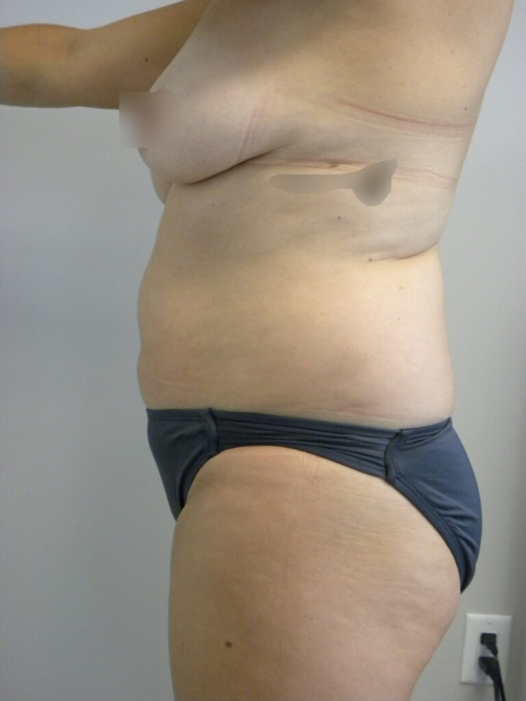 Tummy Tuck Before and After Pictures in Miami, FL