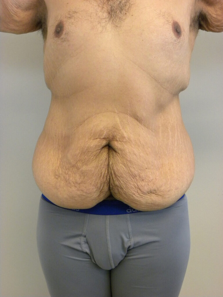Plastic Surgery Before and After Pictures in Miami, FL - Dr. Adam J. Rubinstein 