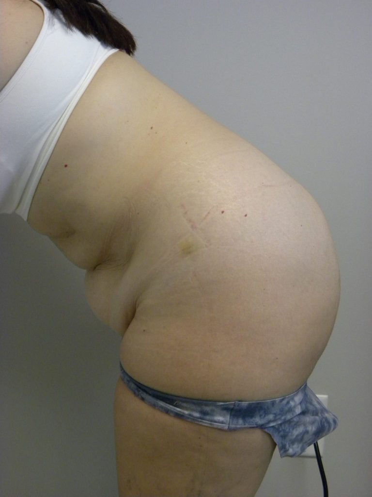 Tummy Tuck Before and After Pictures Miami, FL