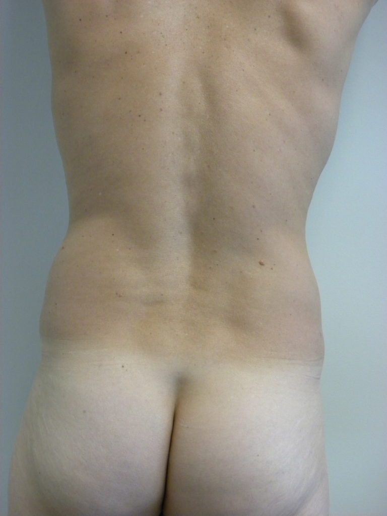 LIPOSUCTION BEFORE AND AFTER PICTURES IN MIAMI, FL