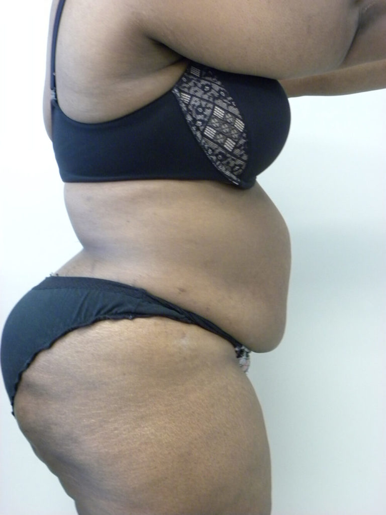 Tummy Tuck Before and After Pictures in Miami, FL