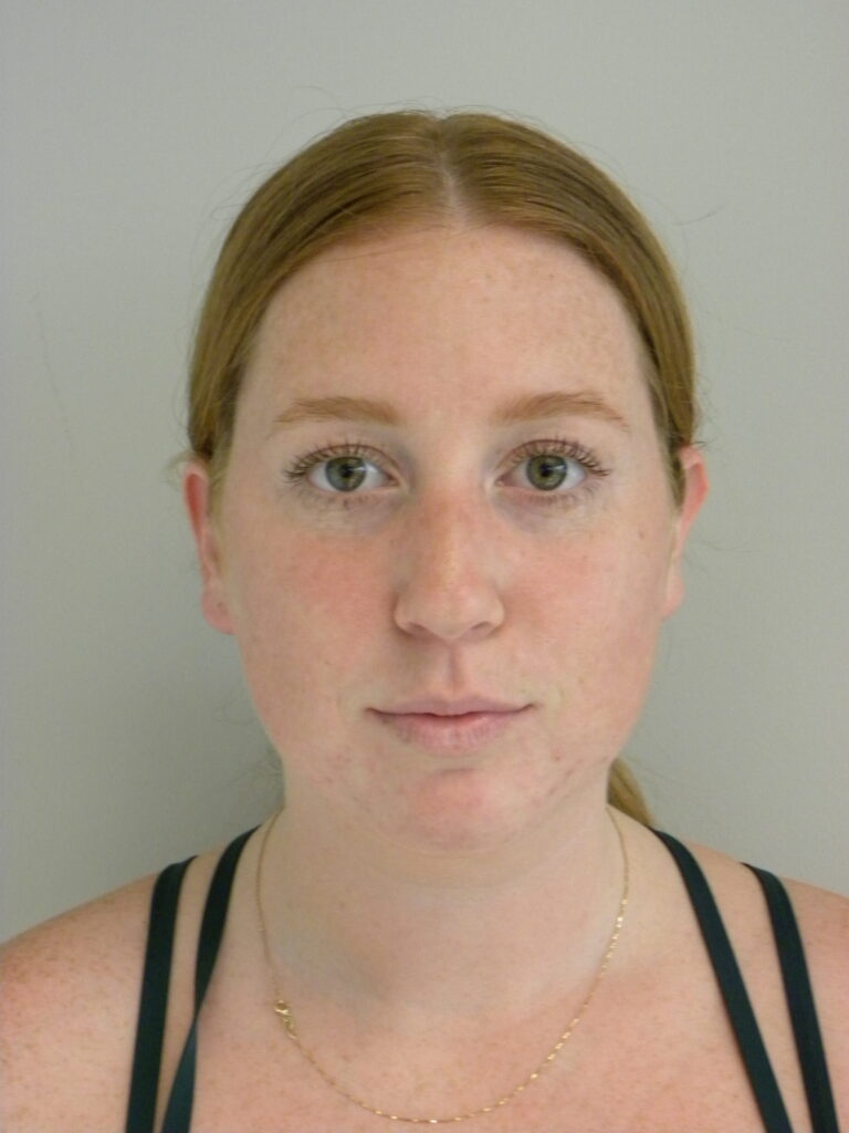 Plastic Surgery Before and After Pictures in Miami, FL - Dr. Adam J. Rubinstein 