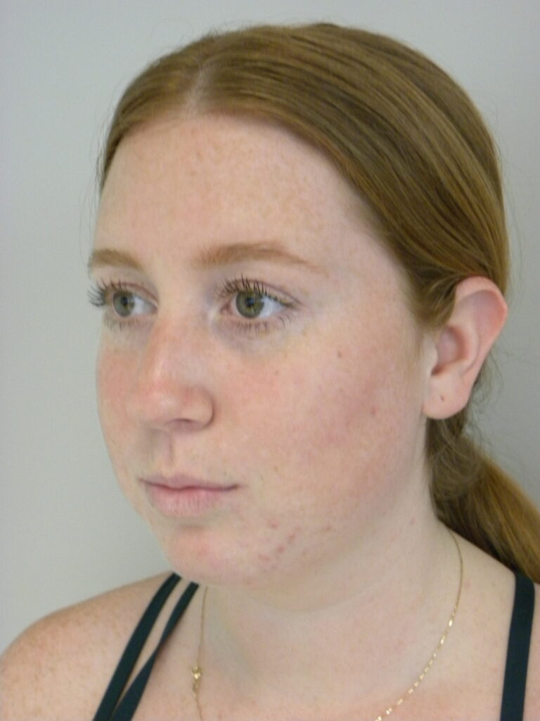 Plastic Surgery Before and After Pictures in Miami, FL - Dr. Adam J. Rubinstein 