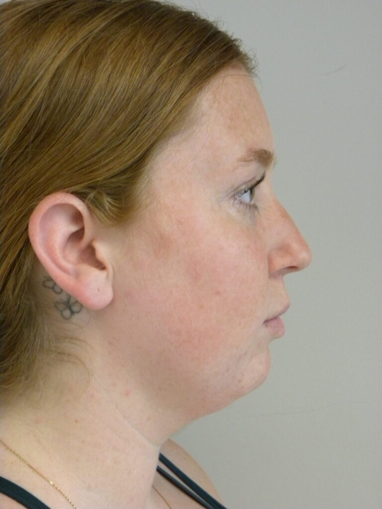 Plastic Surgery Before and After Pictures in Miami, FL - Dr. Adam J. Rubinstein 