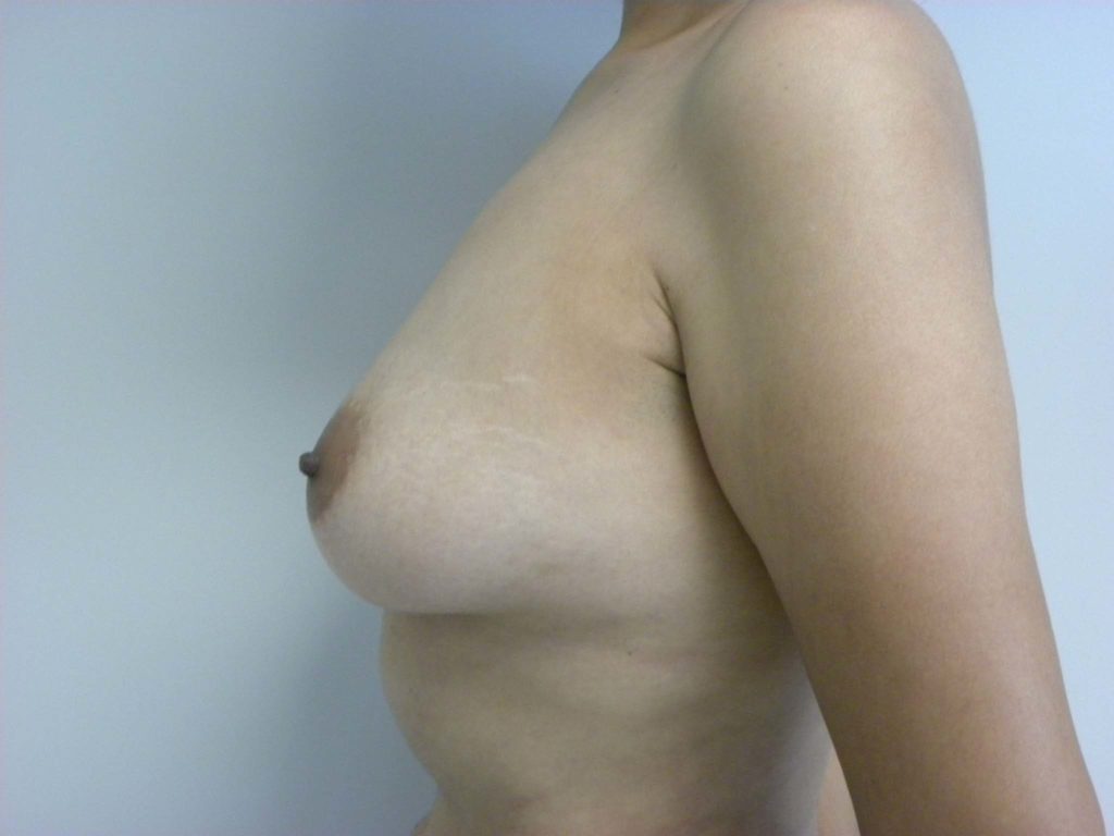 Breast Augmentation Before and After Pictures in Miami, FL