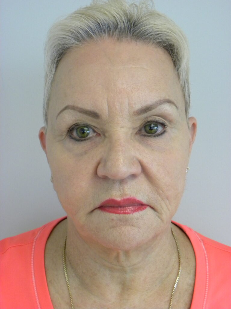 Plastic Surgery Before and After Pictures in Miami, FL - Dr. Adam J. Rubinstein 