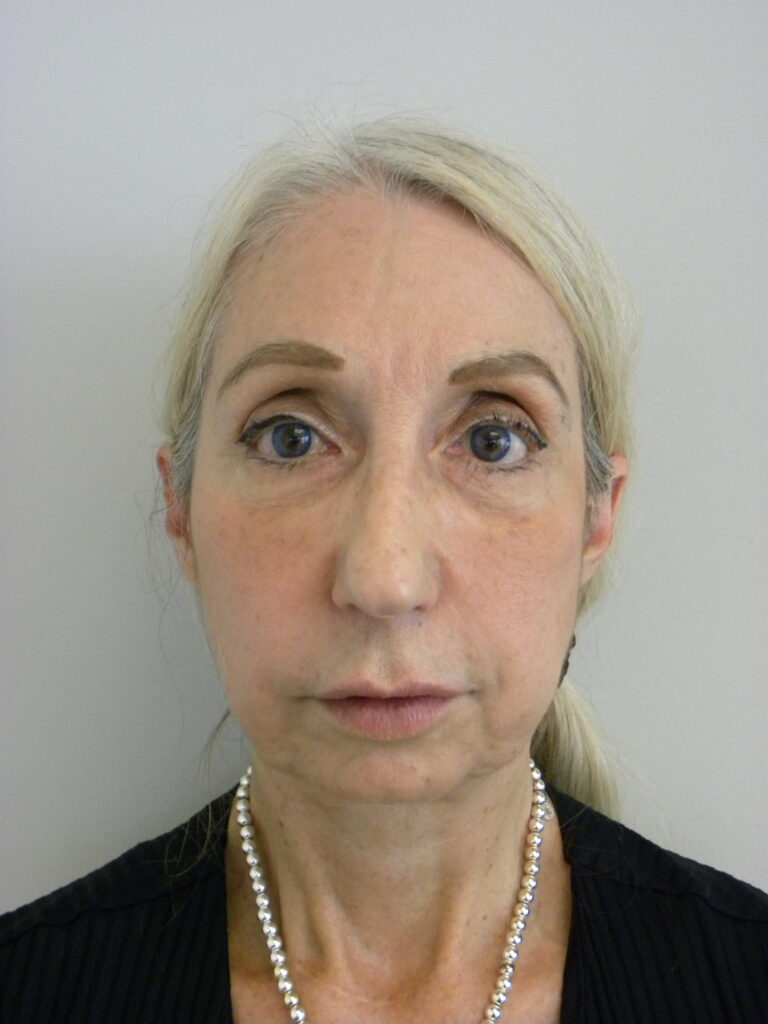 Plastic Surgery Before and After Pictures in Miami, FL - Dr. Adam J. Rubinstein 