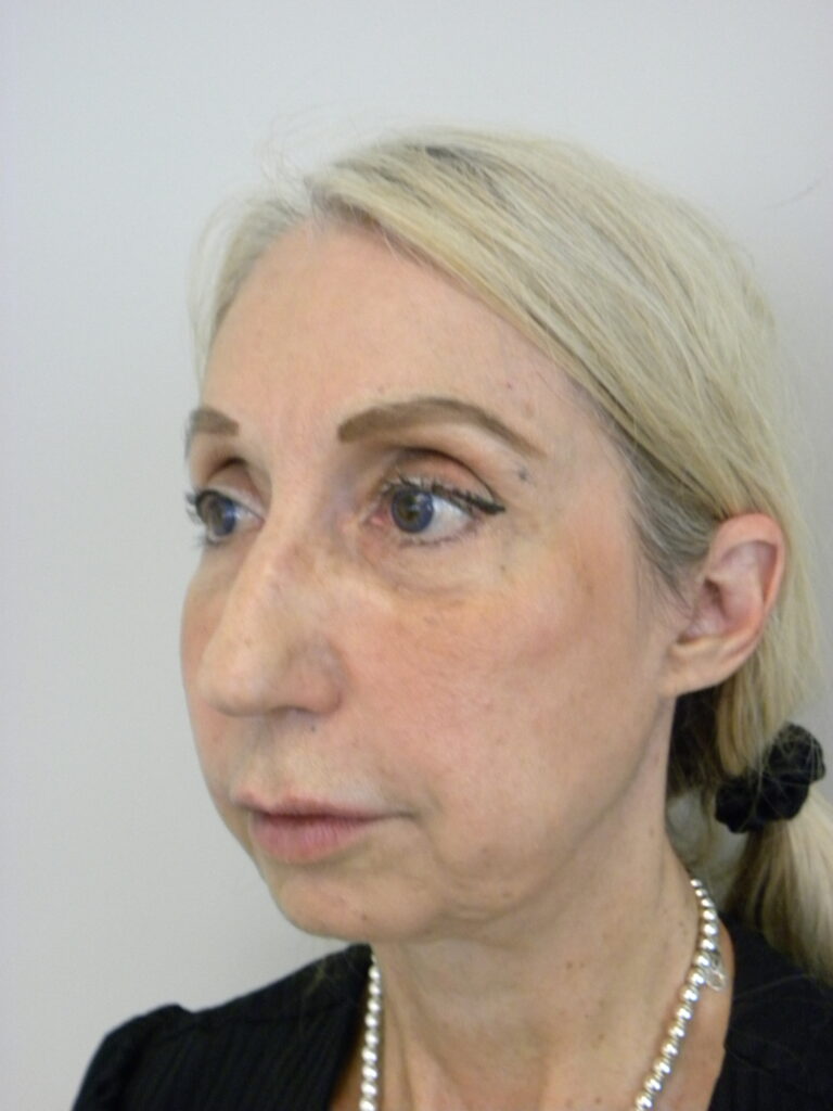 Plastic Surgery Before and After Pictures in Miami, FL - Dr. Adam J. Rubinstein 