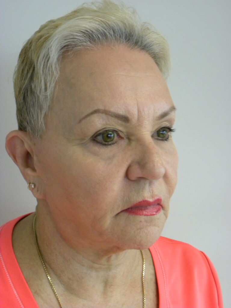 Plastic Surgery Before and After Pictures in Miami, FL - Dr. Adam J. Rubinstein 