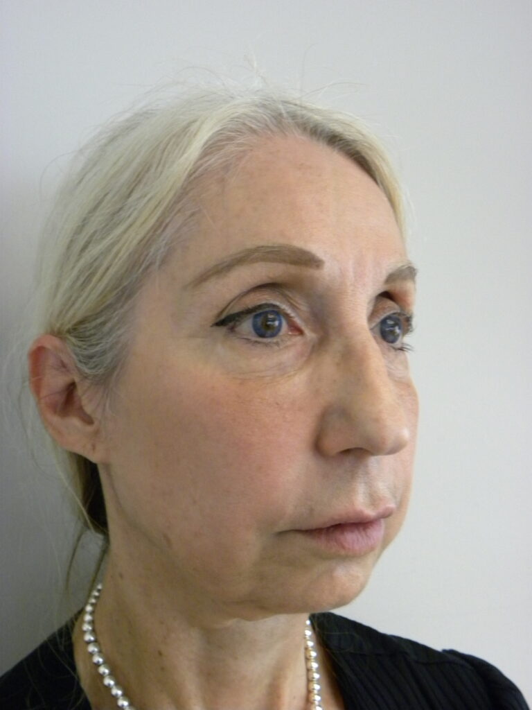 Plastic Surgery Before and After Pictures in Miami, FL - Dr. Adam J. Rubinstein 