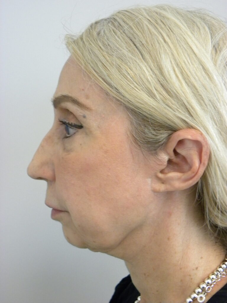 Plastic Surgery Before and After Pictures in Miami, FL - Dr. Adam J. Rubinstein 