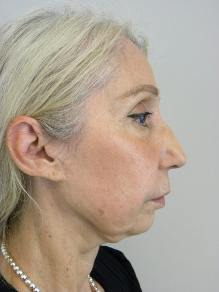 Plastic Surgery Before and After Pictures in Miami, FL - Dr. Adam J. Rubinstein 