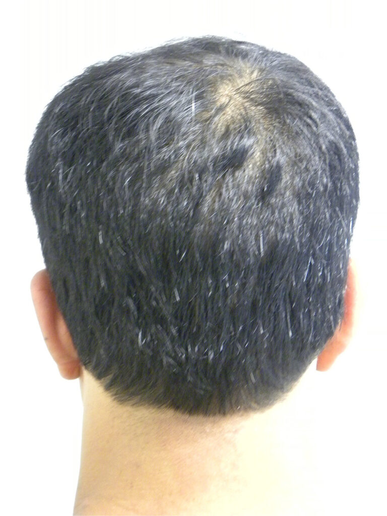 SmartGraft Before and After Pictures in Miami, FL
