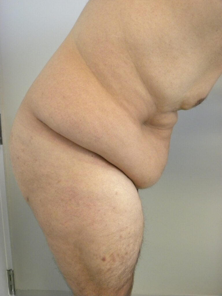 Plastic Surgery Before and After Pictures in Miami, FL - Dr. Adam J. Rubinstein 