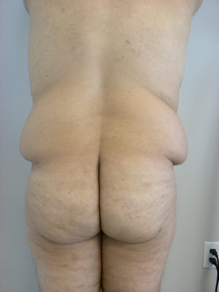 Plastic Surgery Before and After Pictures in Miami, FL - Dr. Adam J. Rubinstein 