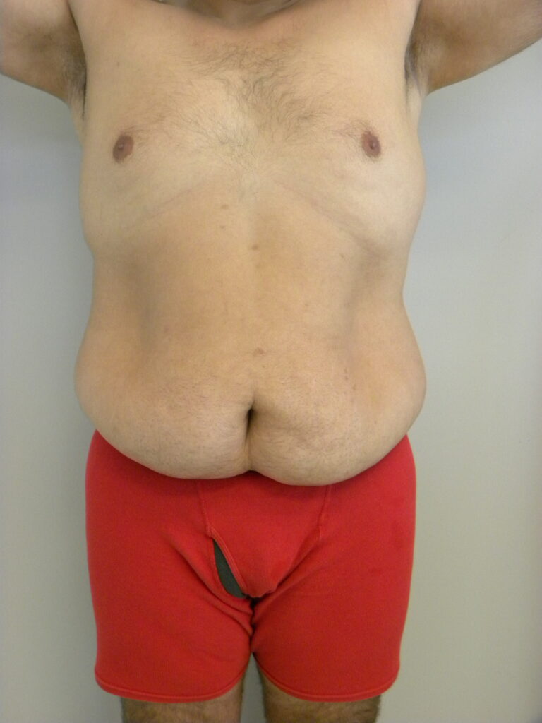 Plastic Surgery Before and After Pictures in Miami, FL - Dr. Adam J. Rubinstein 