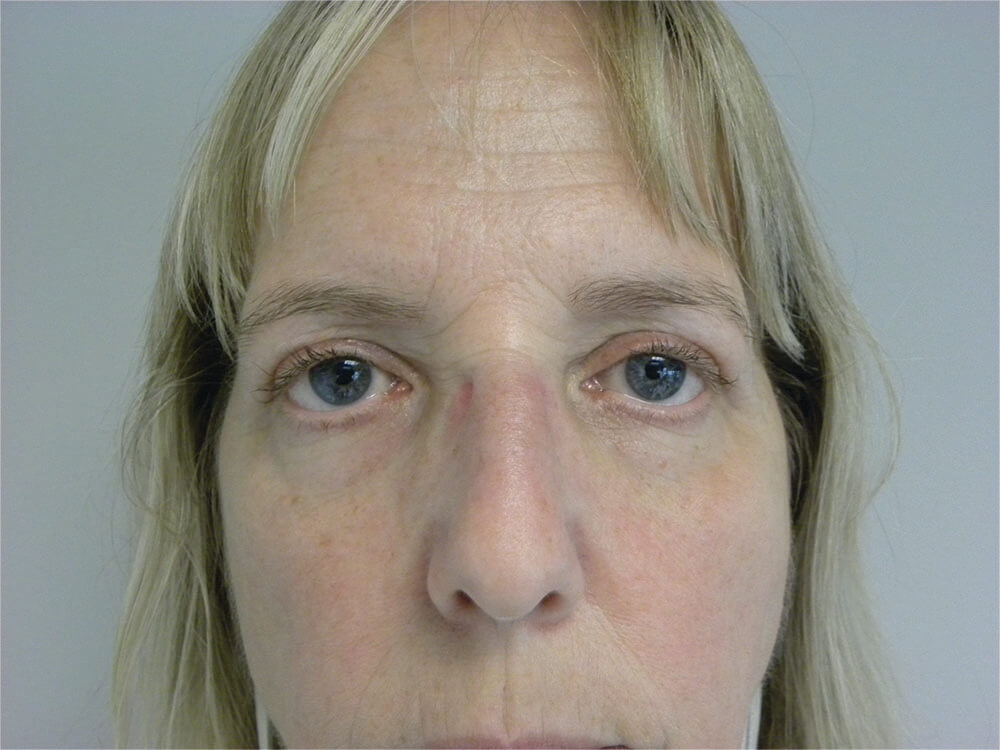 Blepharoplasty Before and After Pictures in Miami, FL